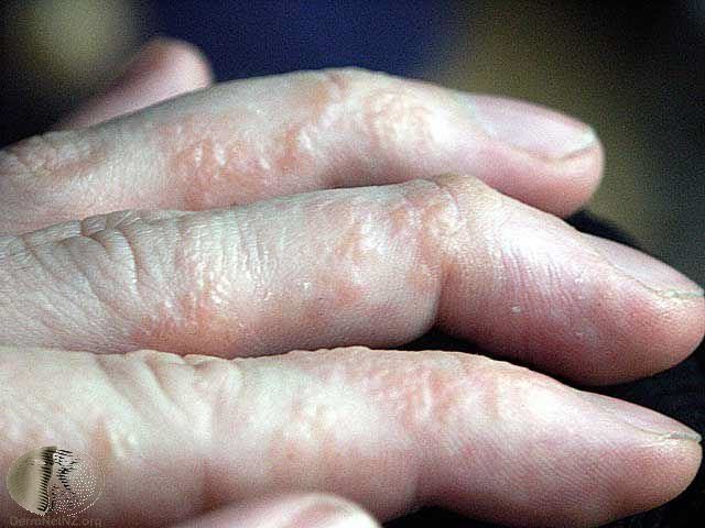 these-9-weird-symptoms-could-be-a-sign-of-rheumatoid-arthritis